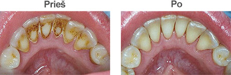 dantu isvaizda pries ir po profesionalios higienos