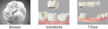 Dantų protezavimas ← Dantų Estetinis plombavimas